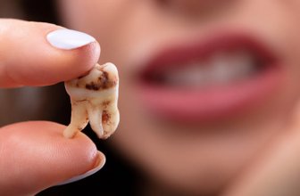 How to Prevent Tooth Decay Naturally?