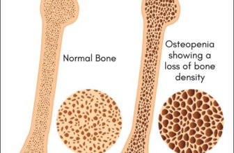 Natural Ayurvedic Treatment for Osteopenia With Herbal Remedies