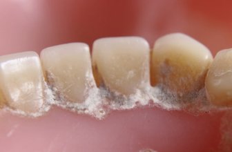 9 Simple Steps to Remove Hard Plaque from Teeth Naturally